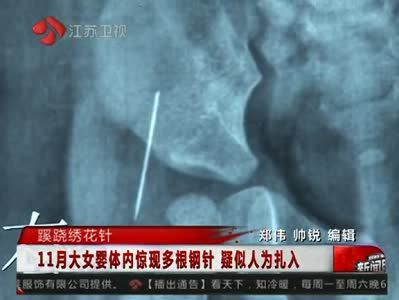 女嬰體內(nèi)4根繡花針