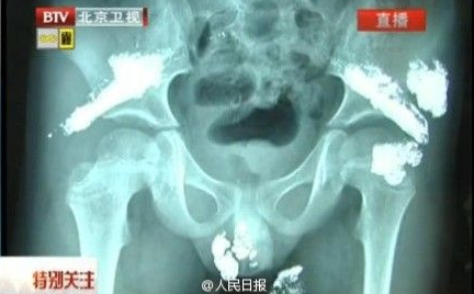 5歲男童被灌大量汞