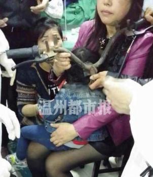 樂(lè)清小女孩頭部扎進(jìn)螺絲帽 電瓶車頭螺絲帽插進(jìn)后腦