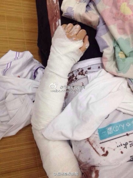 蒼南一中學女生拿剪刀捅傷同學