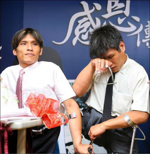 臺(tái)灣連體兄弟
