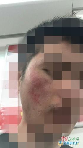 多名大學生毀容 都是因為劣質的化妝品主辦方竟還稱是膚質問題